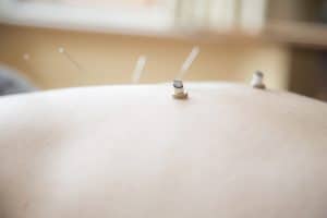 Acupuncture and moxa can help many problems.