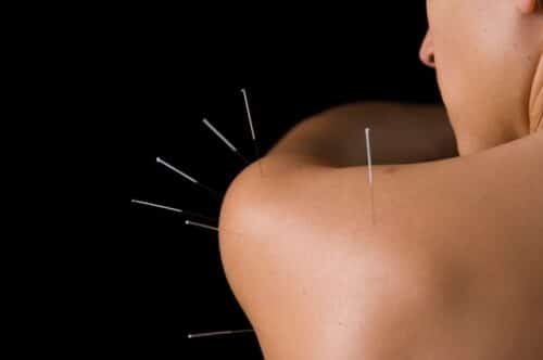 Acupuncture shoulder